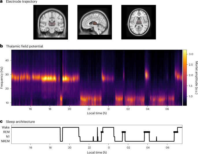 Thalamic oscillations distinguish natural states of consciousness in humans