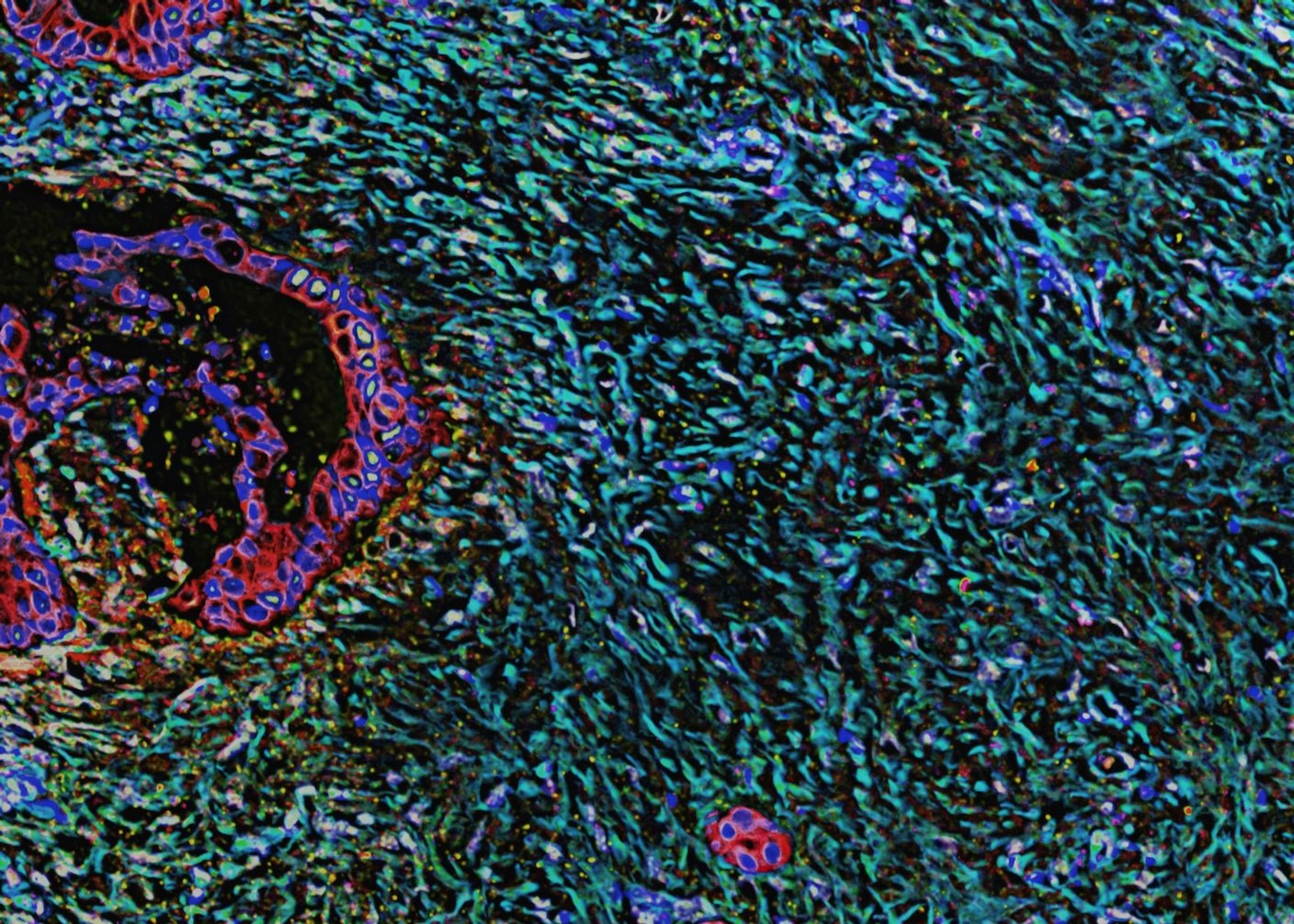 After Decades of Failure, ‘Undruggable’ Cancers Begin to Give Way