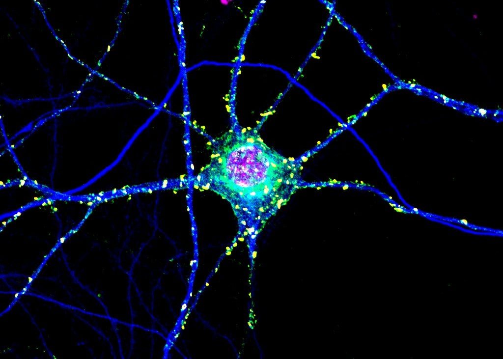 Toxic Clumps in Huntington’s Disease May Protect the Brain Too