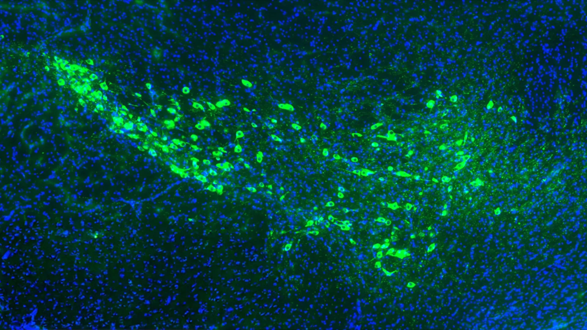 Yale scientists may have found how Parkinson's disease spreads through the brain